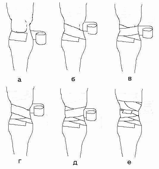Эластичный бинт при артрозе коленного сустава