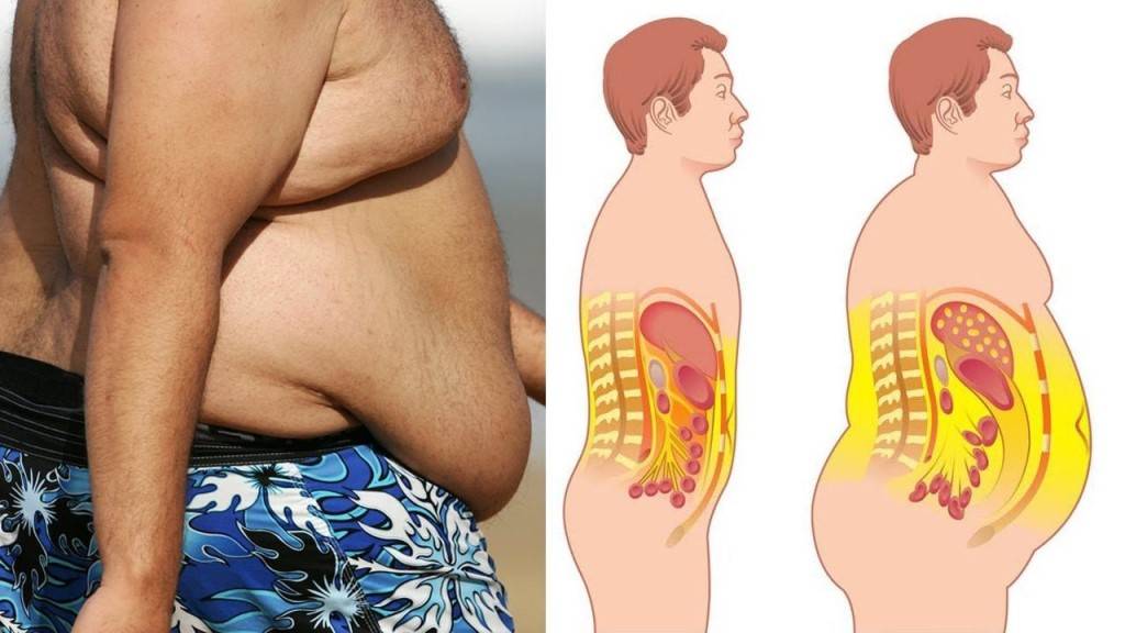 Липомастия - гинекомастия жирового типа | университетская клиника
